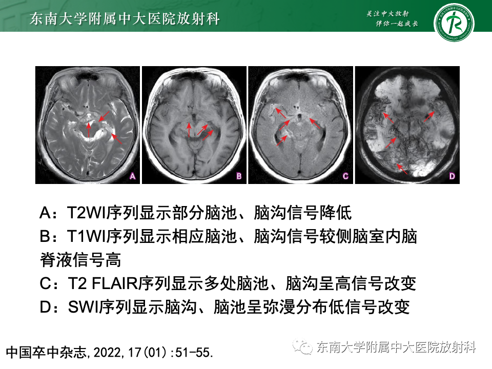 影像PPT - 【PPT】脑皮质层状坏死-34