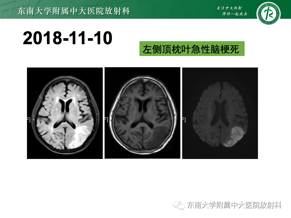 影像PPT - 【PPT】脑皮质层状坏死-2