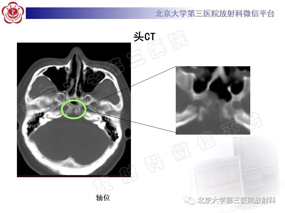 影像PPT - 【PPT】颅底脊索瘤-3
