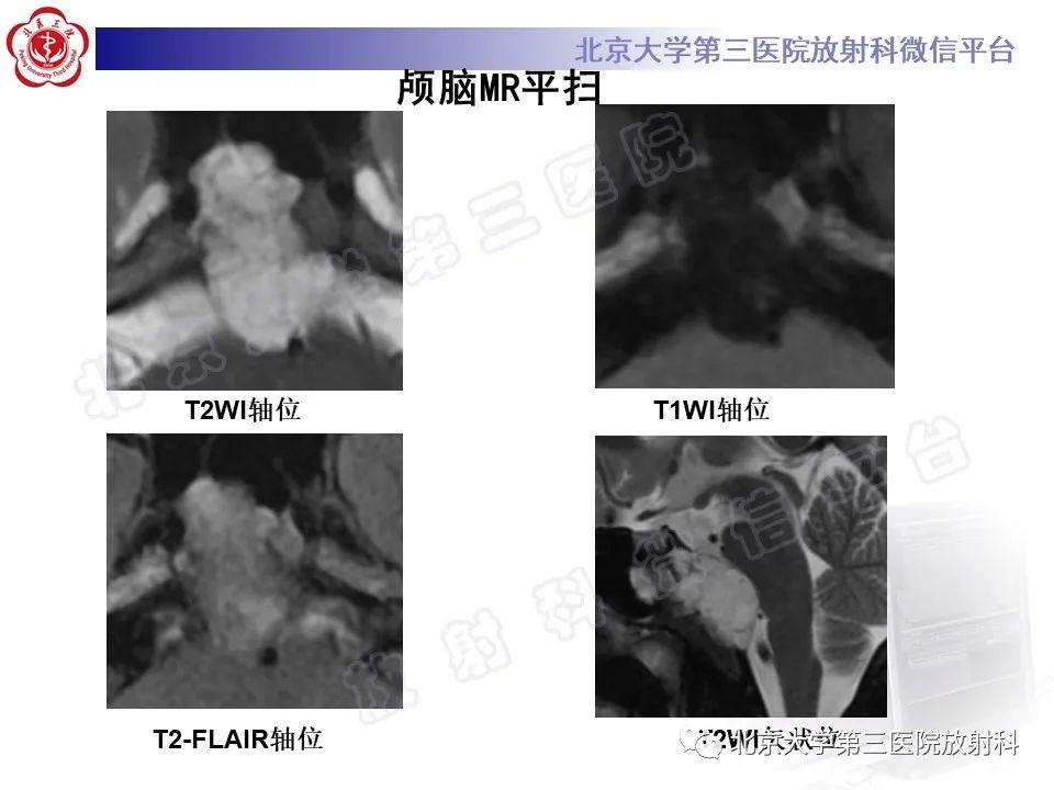 影像PPT - 【PPT】颅底脊索瘤-6