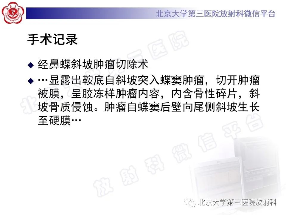 影像PPT - 【PPT】颅底脊索瘤-9