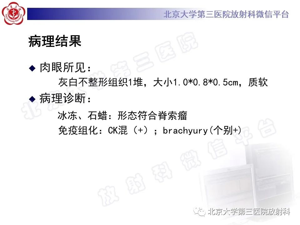 影像PPT - 【PPT】颅底脊索瘤-10