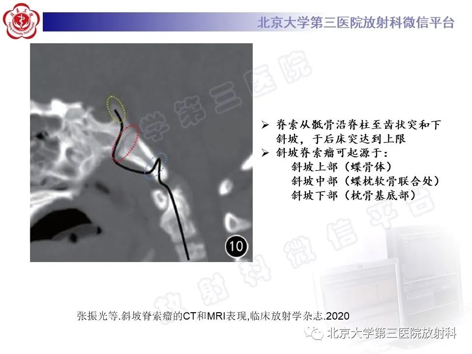 影像PPT - 【PPT】颅底脊索瘤-14