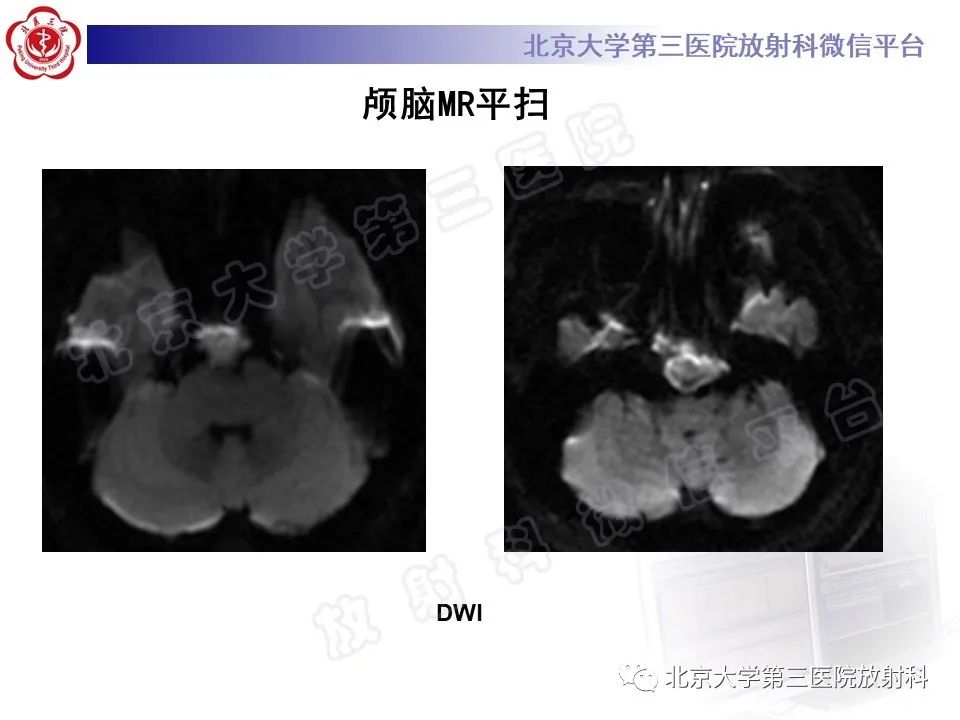影像PPT - 【PPT】颅底脊索瘤-7