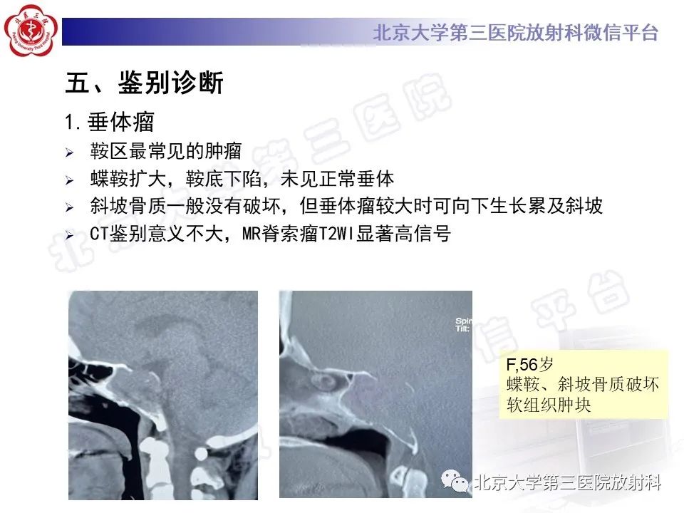影像PPT - 【PPT】颅底脊索瘤-21