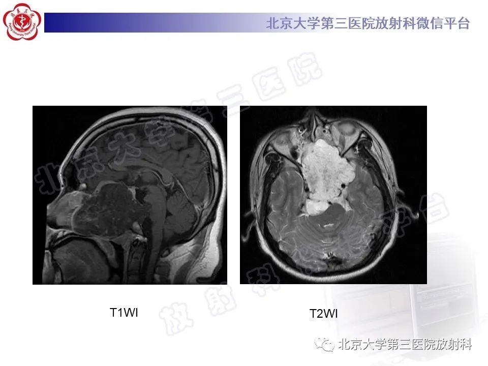 影像PPT - 【PPT】颅底脊索瘤-20