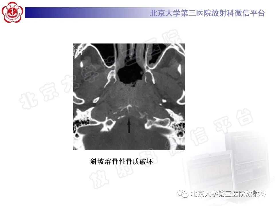 影像PPT - 【PPT】颅底脊索瘤-18