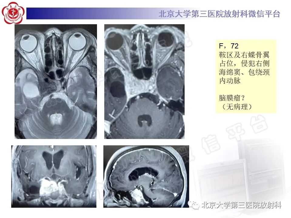影像PPT - 【PPT】颅底脊索瘤-25