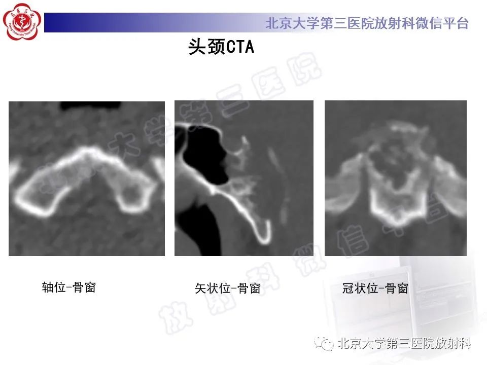 影像PPT - 【PPT】颅底脊索瘤-4