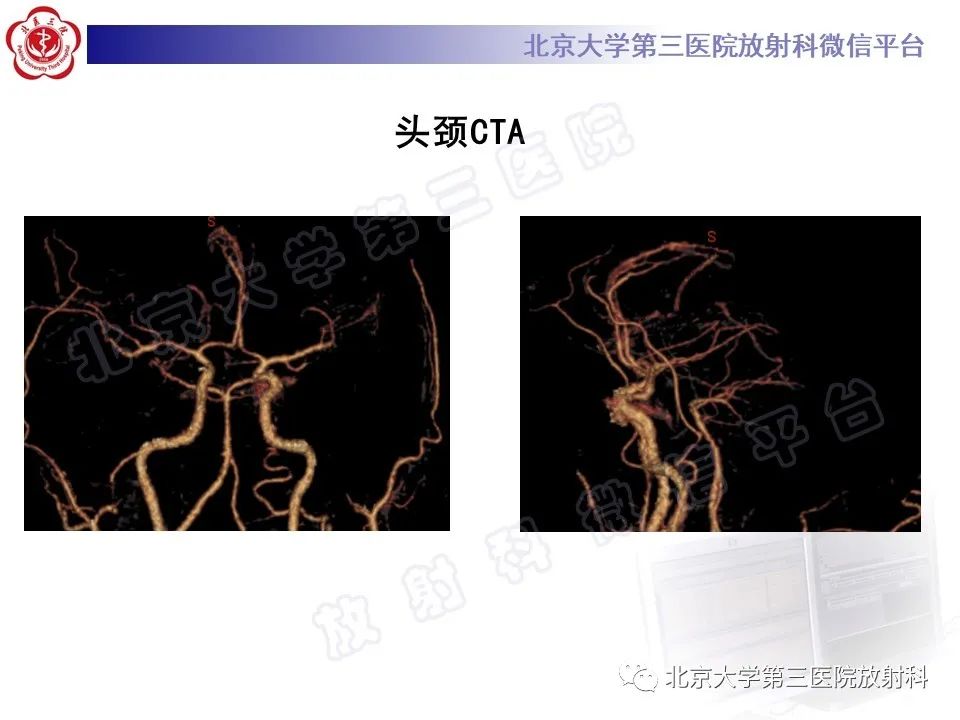 影像PPT - 【PPT】颅底脊索瘤-5