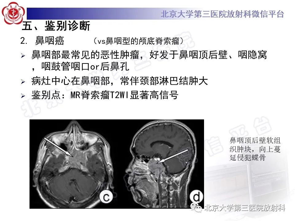 影像PPT - 【PPT】颅底脊索瘤-23