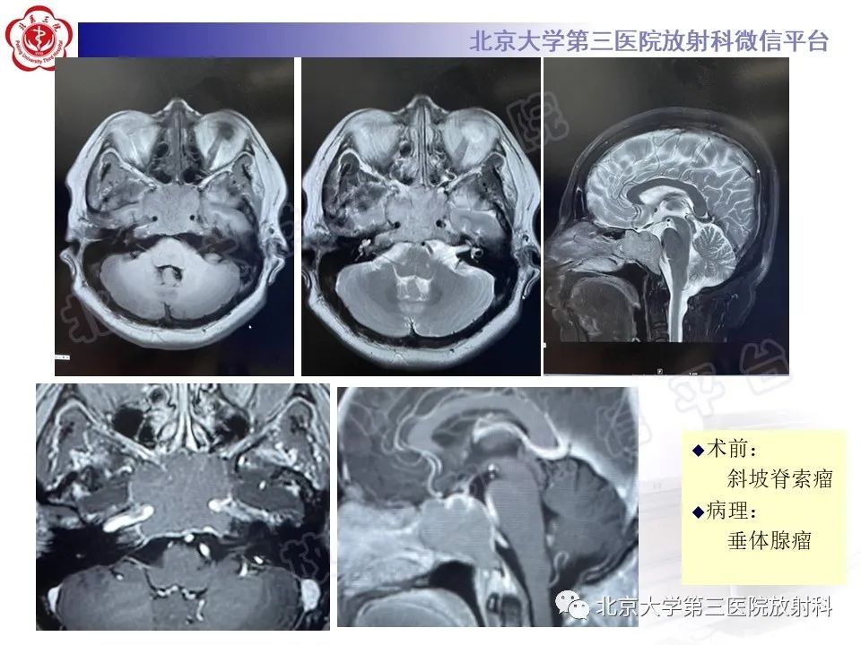 影像PPT - 【PPT】颅底脊索瘤-22