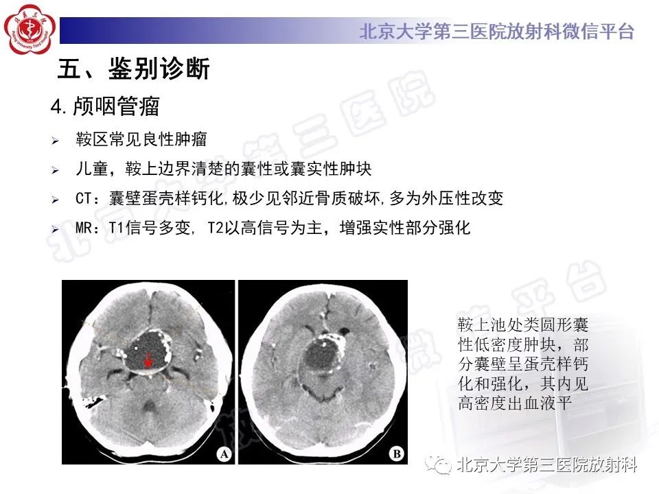 影像PPT - 【PPT】颅底脊索瘤-26