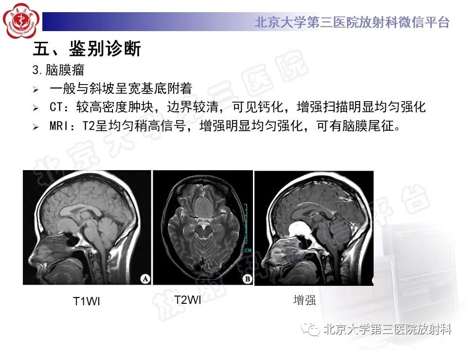 影像PPT - 【PPT】颅底脊索瘤-24