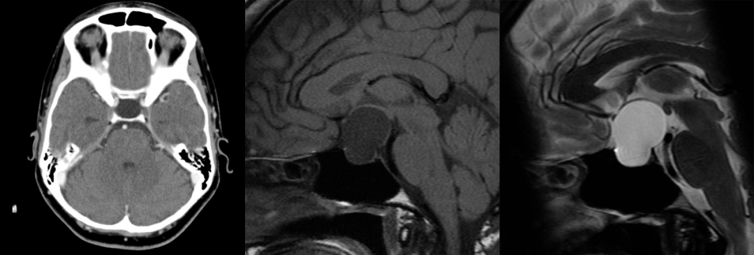 影像PPT - 【病例】Rathke’s 囊肿1例MR影像诊断-14 影像PPT - 【病例】Rathke’s 囊肿1例MR影像诊断-14
