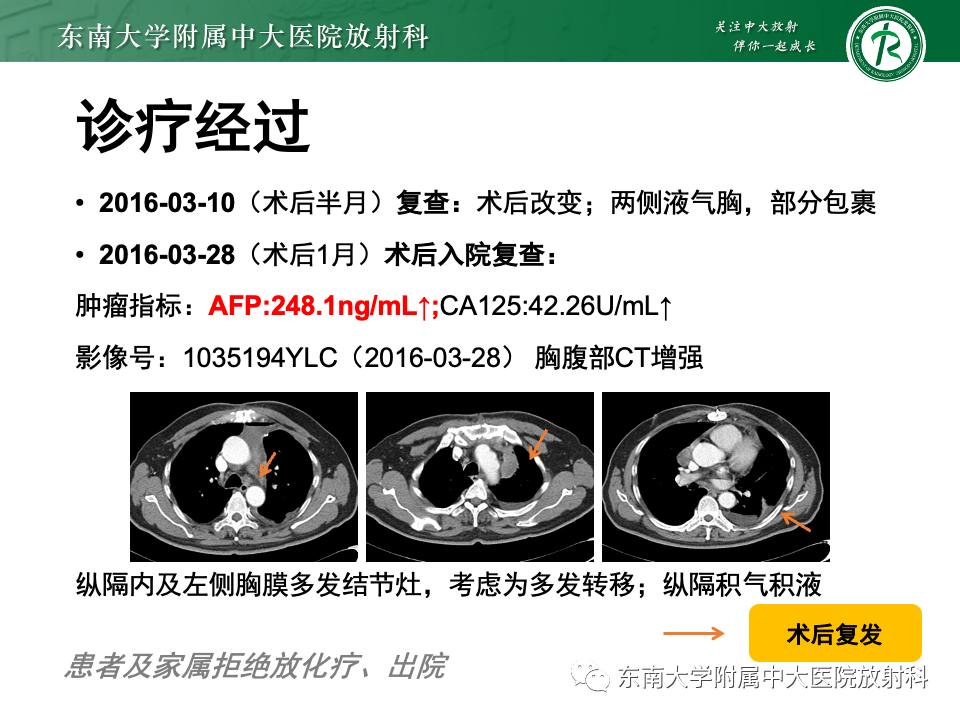 影像PPT - 【PPT】纵隔生殖细胞肿瘤-6 影像PPT - 【PPT】纵隔生殖细胞肿瘤-6