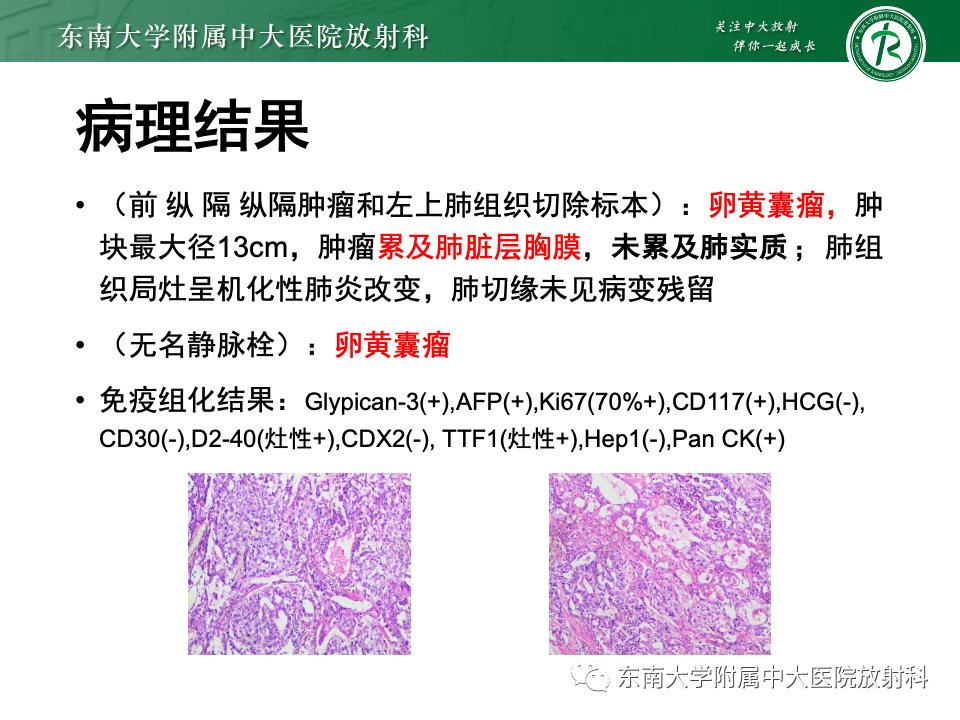 影像PPT - 【PPT】纵隔生殖细胞肿瘤-5 影像PPT - 【PPT】纵隔生殖细胞肿瘤-5