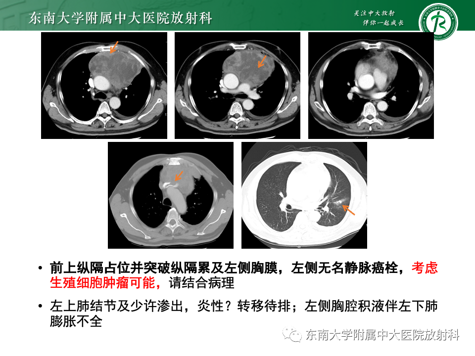 影像PPT - 【PPT】纵隔生殖细胞肿瘤-3 影像PPT - 【PPT】纵隔生殖细胞肿瘤-3