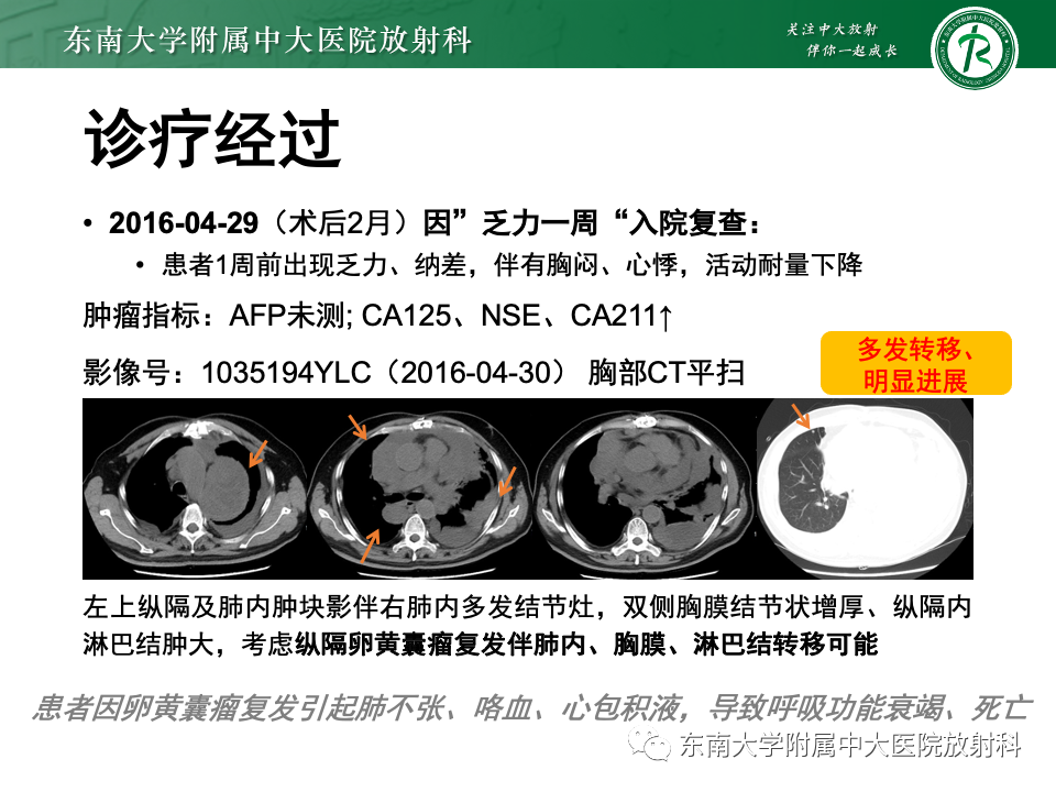 影像PPT - 【PPT】纵隔生殖细胞肿瘤-7 影像PPT - 【PPT】纵隔生殖细胞肿瘤-7
