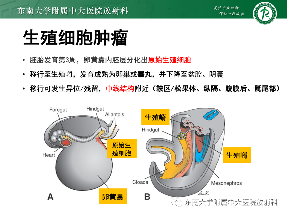 影像PPT - 【PPT】纵隔生殖细胞肿瘤-10 影像PPT - 【PPT】纵隔生殖细胞肿瘤-10