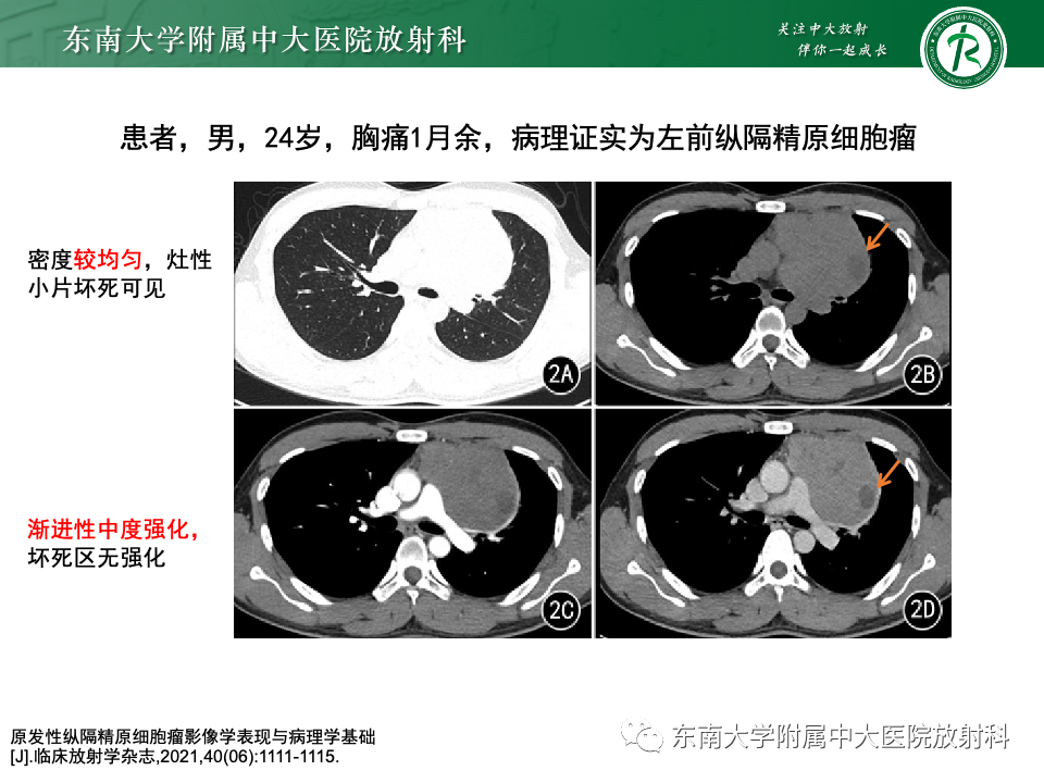 影像PPT - 【PPT】纵隔生殖细胞肿瘤-22 影像PPT - 【PPT】纵隔生殖细胞肿瘤-22
