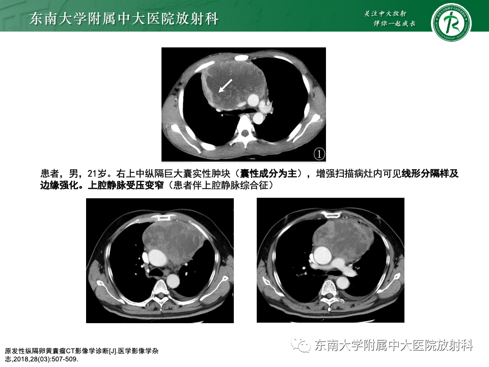 影像PPT - 【PPT】纵隔生殖细胞肿瘤-25 影像PPT - 【PPT】纵隔生殖细胞肿瘤-25