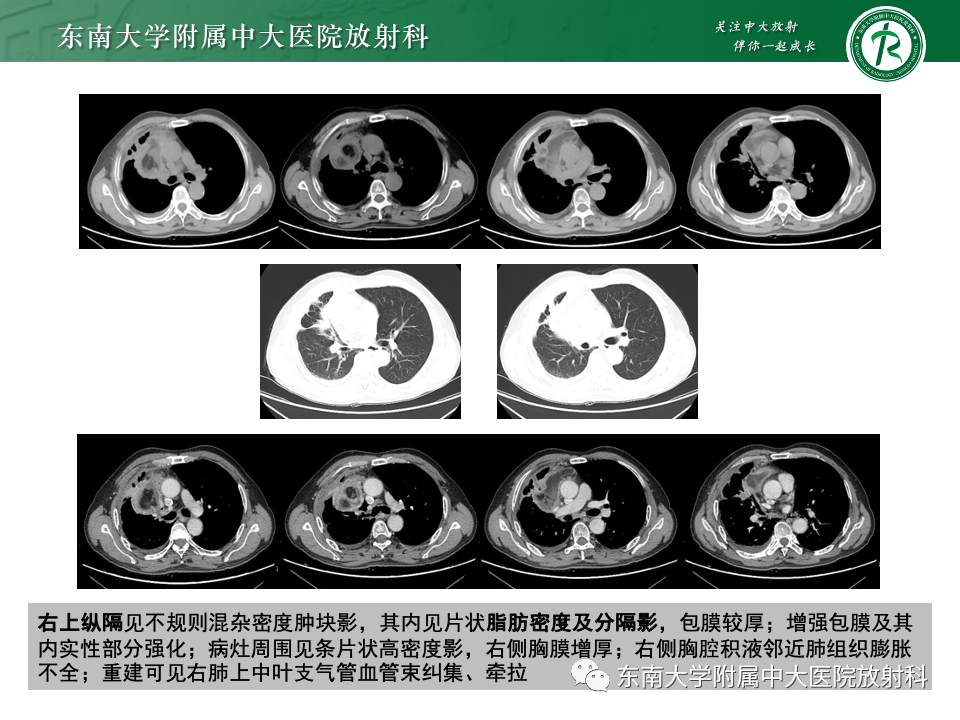 影像PPT - 【PPT】纵隔生殖细胞肿瘤-30 影像PPT - 【PPT】纵隔生殖细胞肿瘤-30