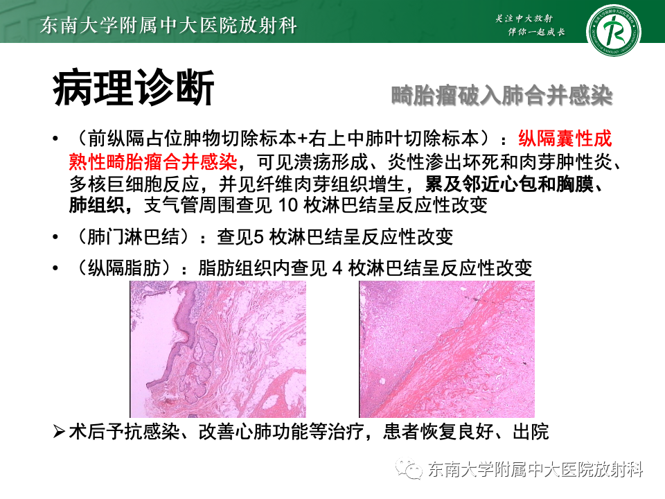 影像PPT - 【PPT】纵隔生殖细胞肿瘤-32 影像PPT - 【PPT】纵隔生殖细胞肿瘤-32