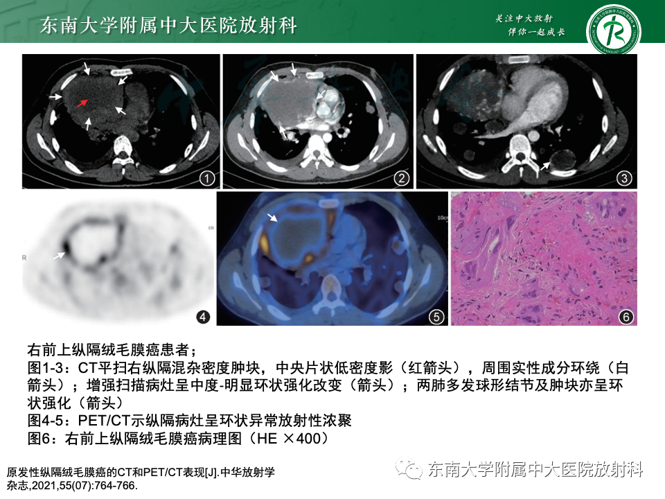 影像PPT - 【PPT】纵隔生殖细胞肿瘤-35 影像PPT - 【PPT】纵隔生殖细胞肿瘤-35