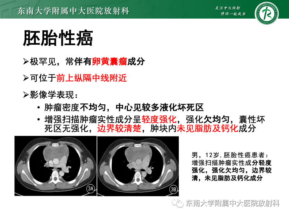 影像PPT - 【PPT】纵隔生殖细胞肿瘤-36 影像PPT - 【PPT】纵隔生殖细胞肿瘤-36