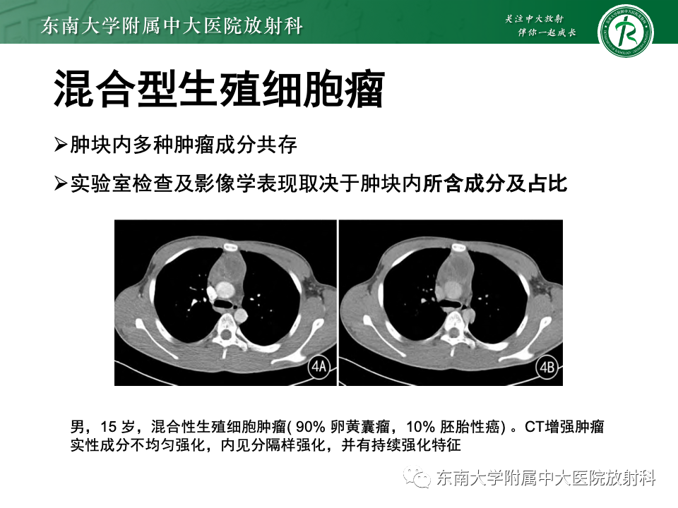 影像PPT - 【PPT】纵隔生殖细胞肿瘤-37 影像PPT - 【PPT】纵隔生殖细胞肿瘤-37