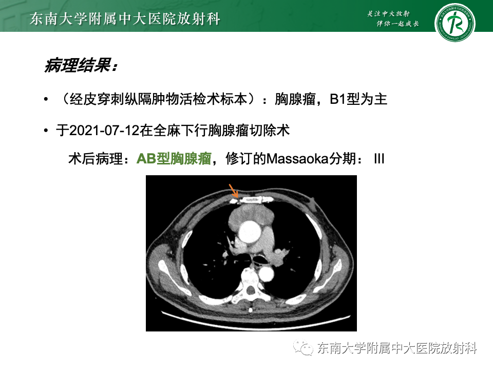 影像PPT - 【PPT】纵隔生殖细胞肿瘤-41 影像PPT - 【PPT】纵隔生殖细胞肿瘤-41