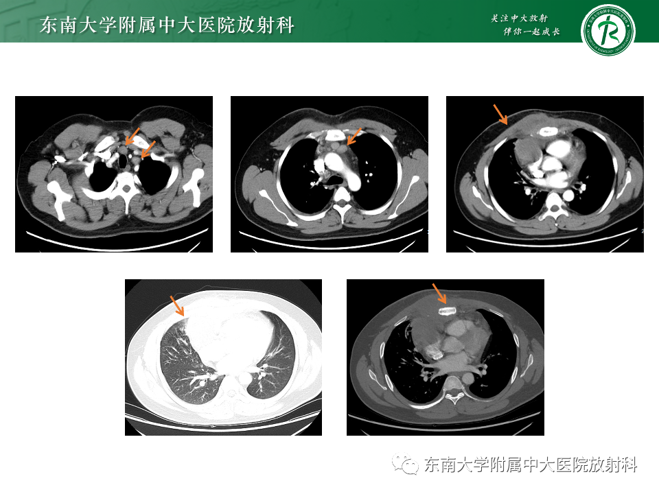 影像PPT - 【PPT】纵隔生殖细胞肿瘤-44 影像PPT - 【PPT】纵隔生殖细胞肿瘤-44