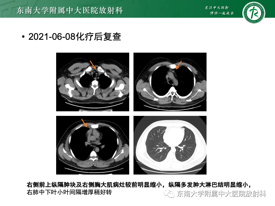 影像PPT - 【PPT】纵隔生殖细胞肿瘤-46 影像PPT - 【PPT】纵隔生殖细胞肿瘤-46