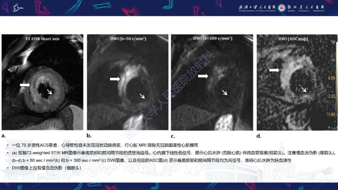 影像PPT - 【PPT】心脏MRI在急诊胸痛患者中的应用-30