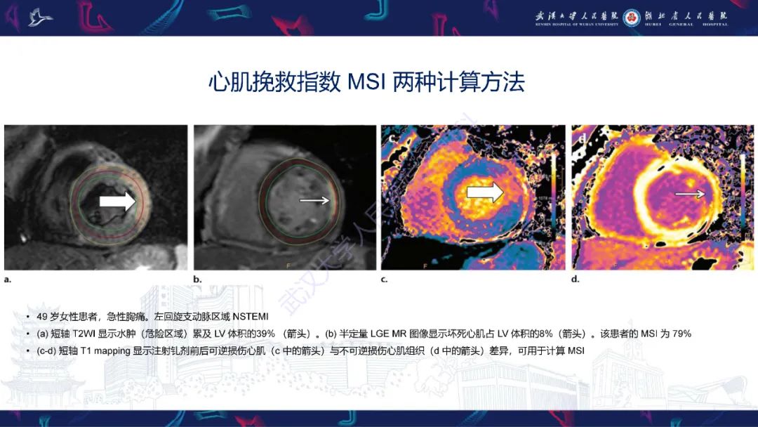 影像PPT - 【PPT】心脏MRI在急诊胸痛患者中的应用-38