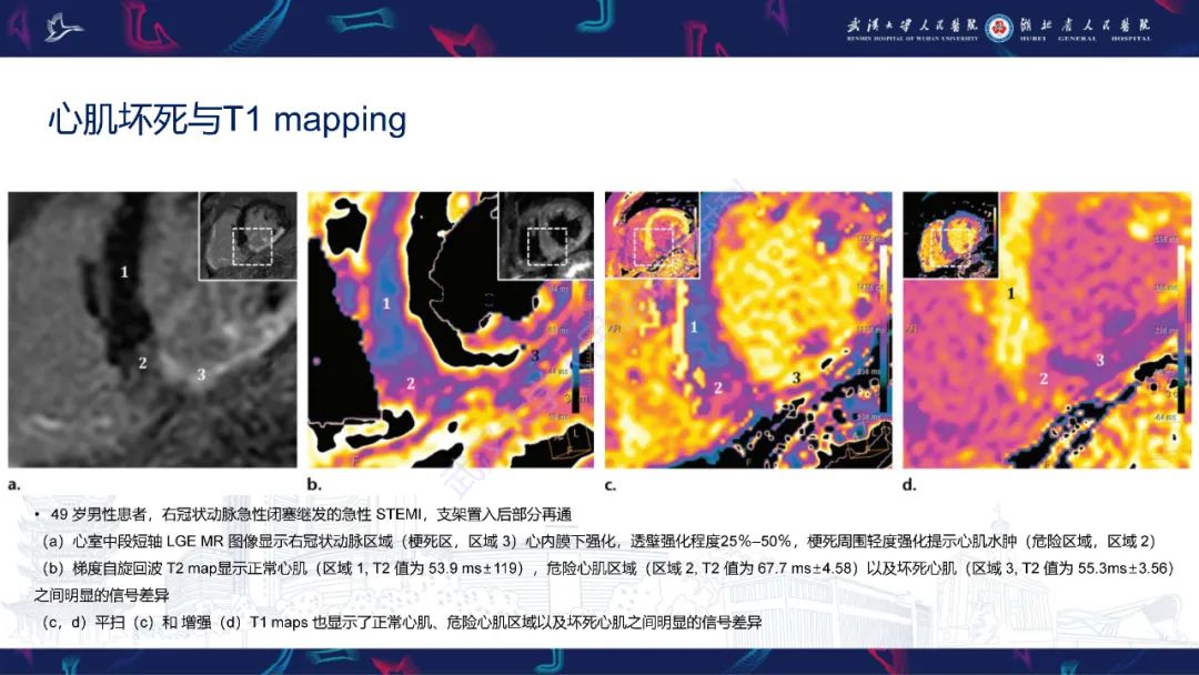 影像PPT - 【PPT】心脏MRI在急诊胸痛患者中的应用-39