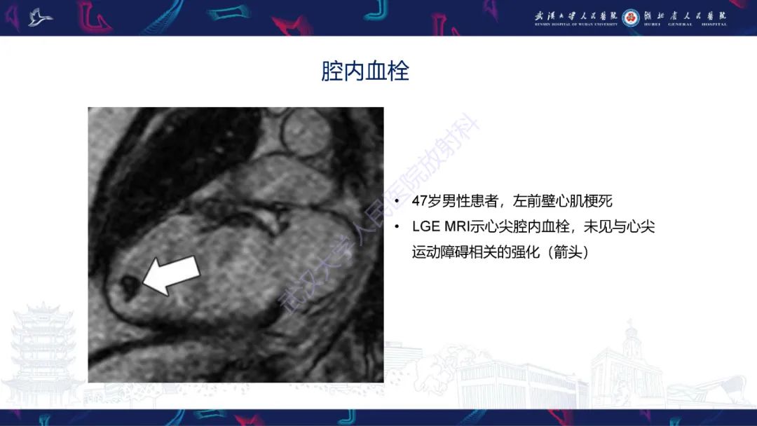 影像PPT - 【PPT】心脏MRI在急诊胸痛患者中的应用-57