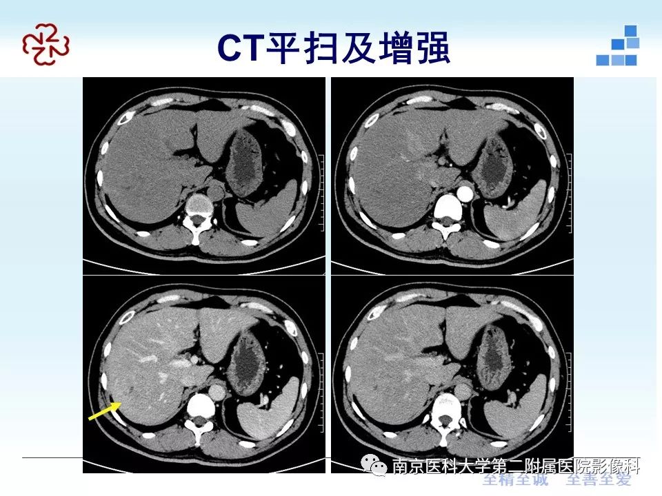 影像PPT - 【病例】肝脏炎性肌纤维母细胞瘤1例MR影像-31