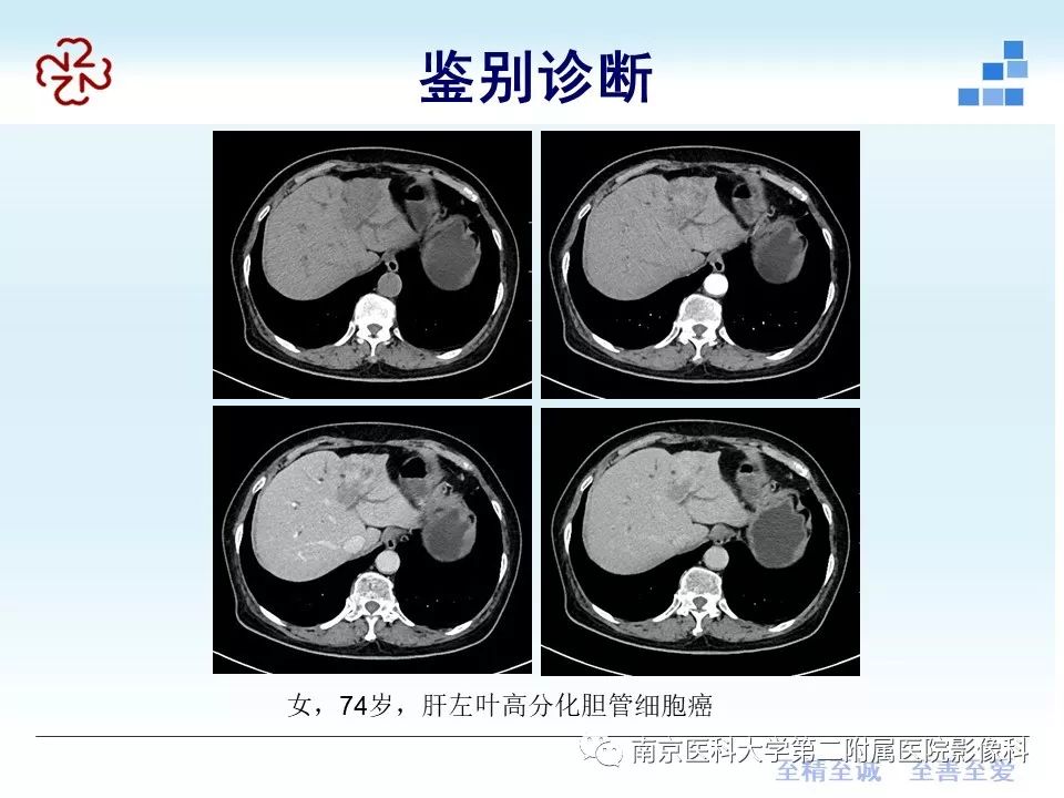 影像PPT - 【病例】肝脏炎性肌纤维母细胞瘤1例MR影像-41