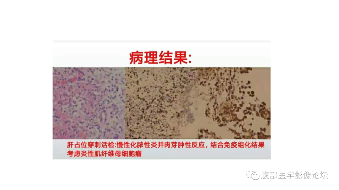 影像PPT - 【病例】肝脏炎性肌纤维母细胞瘤1例MR影像-11