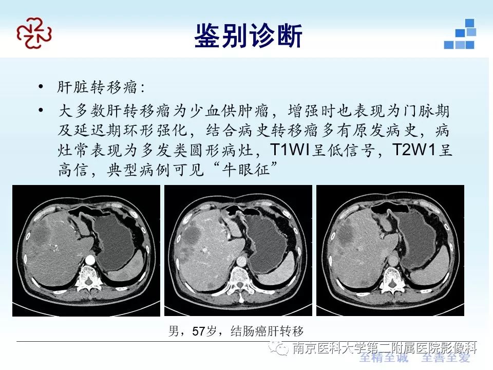 影像PPT - 【病例】肝脏炎性肌纤维母细胞瘤1例MR影像-7