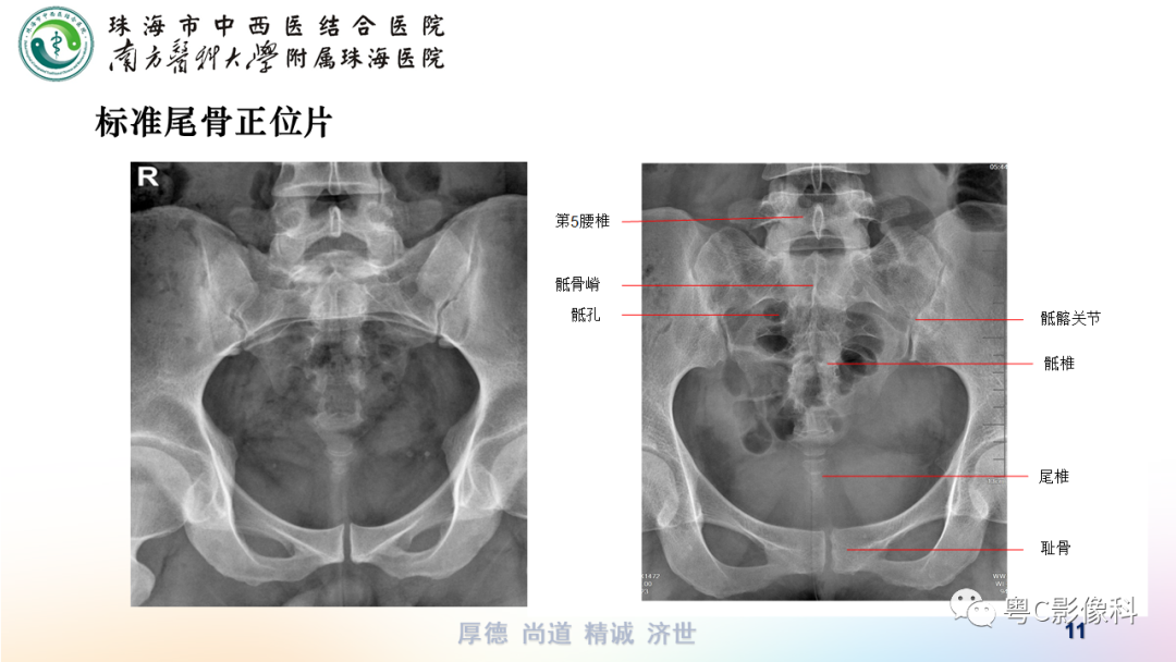 影像PPT - 【PPT】骶尾骨正侧位X线摄影-11