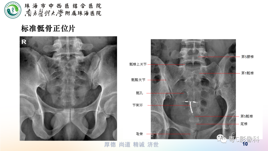 影像PPT - 【PPT】骶尾骨正侧位X线摄影-10