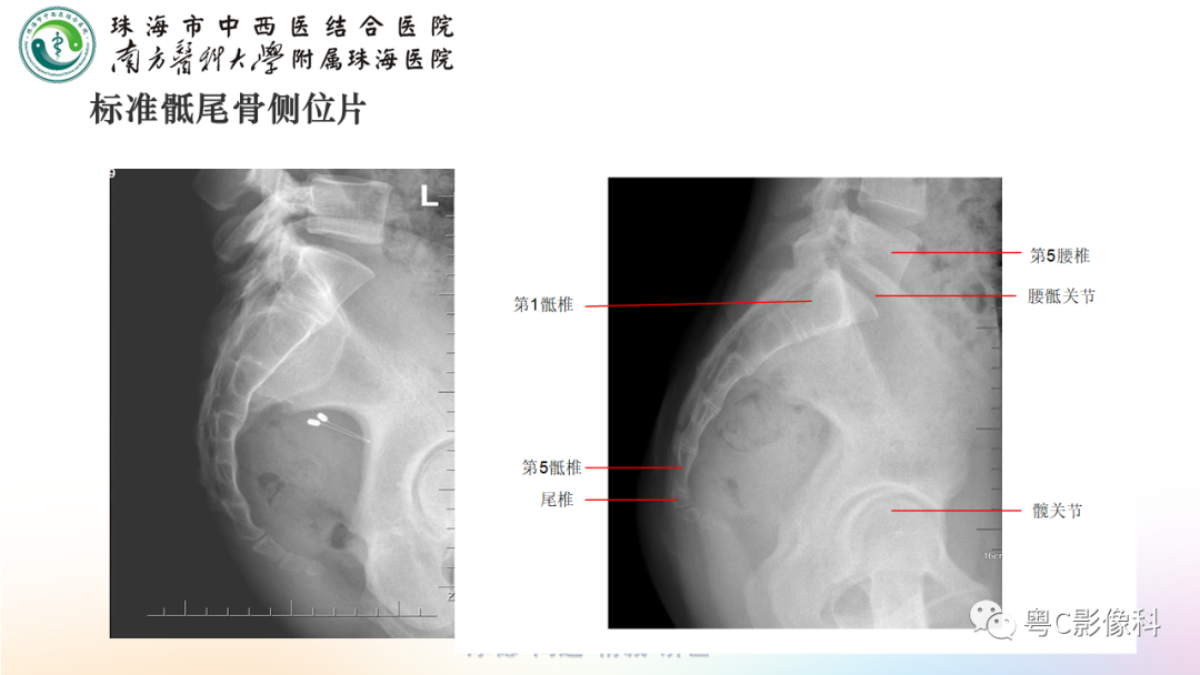 影像PPT - 【PPT】骶尾骨正侧位X线摄影-15