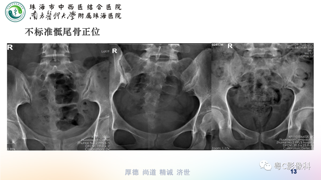 影像PPT - 【PPT】骶尾骨正侧位X线摄影-13