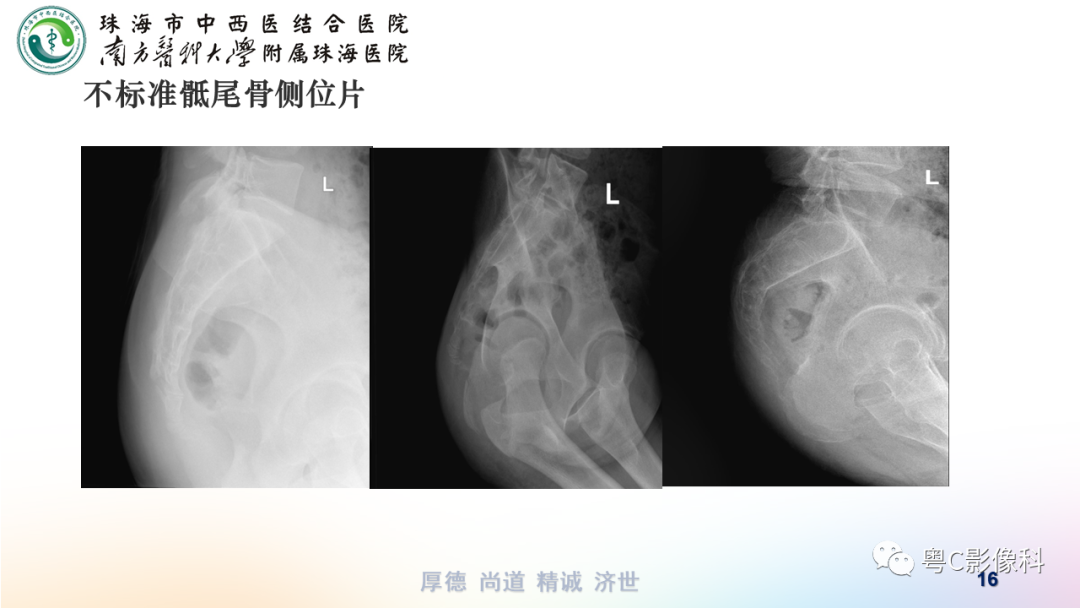 影像PPT - 【PPT】骶尾骨正侧位X线摄影-16