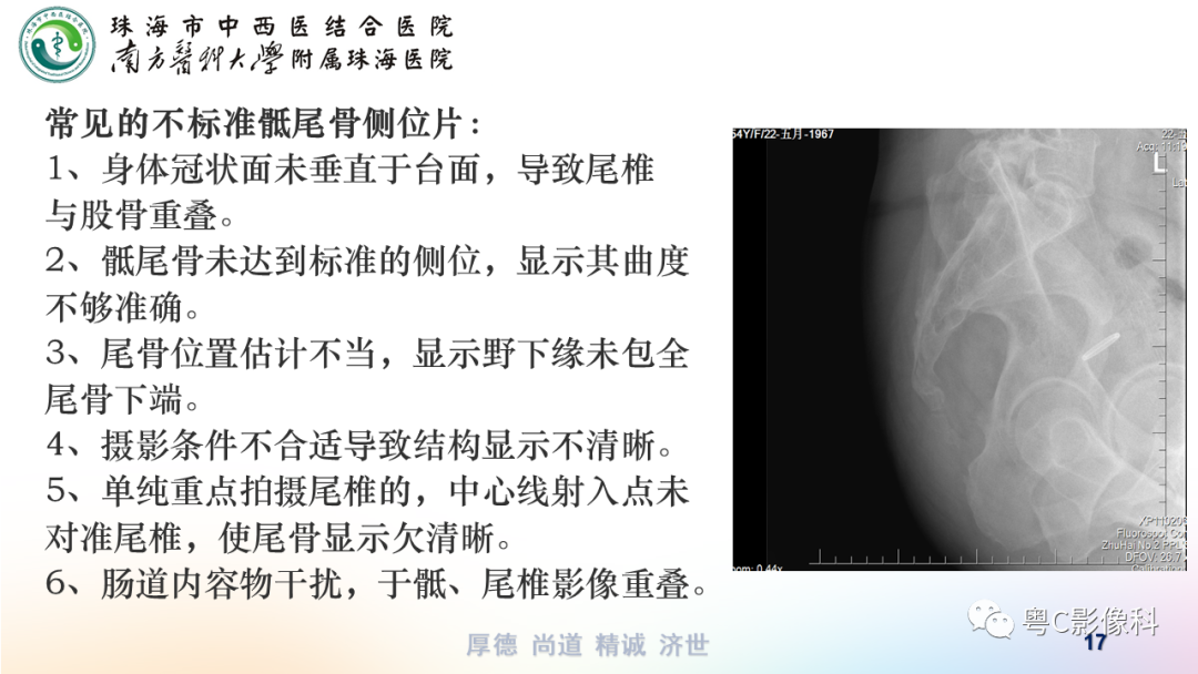 影像PPT - 【PPT】骶尾骨正侧位X线摄影-17