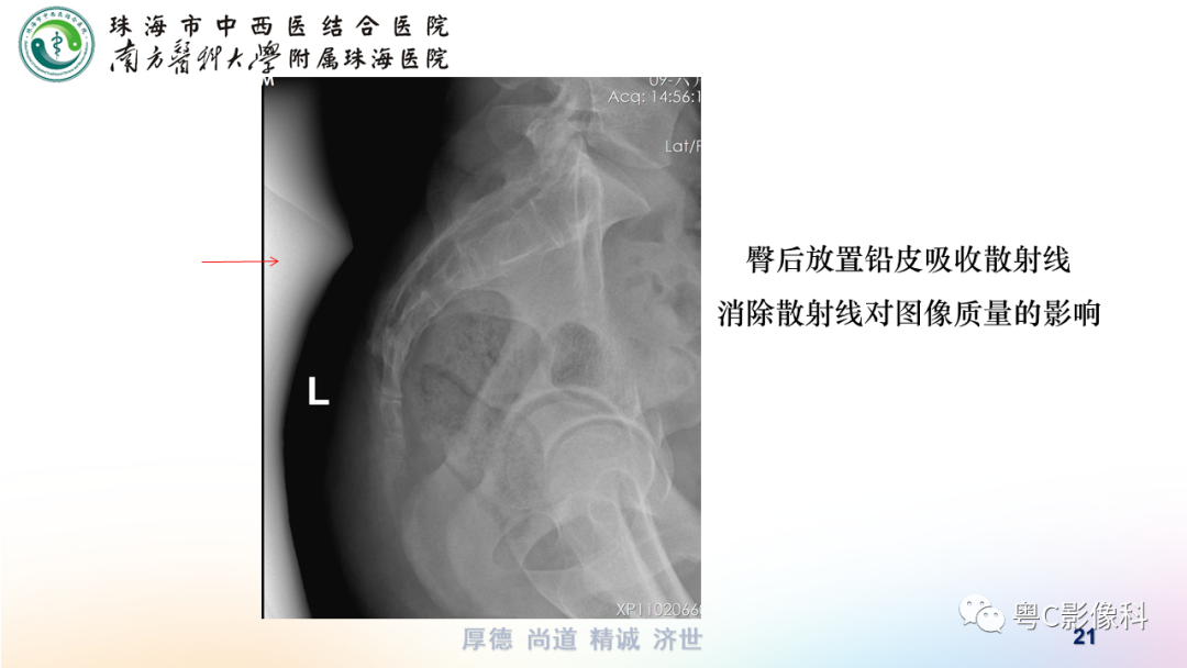 影像PPT - 【PPT】骶尾骨正侧位X线摄影-21