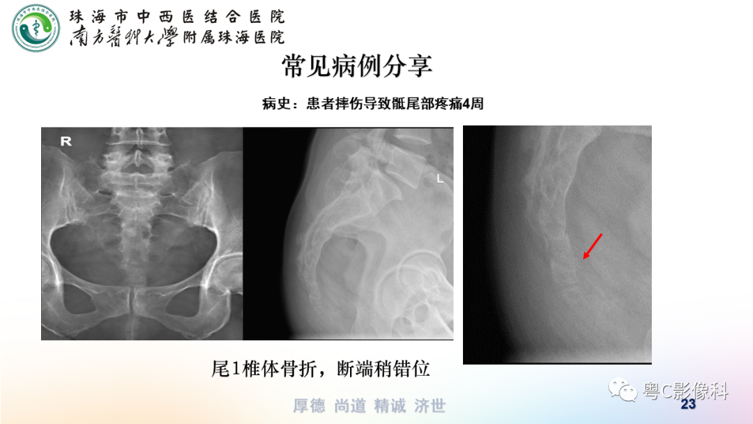 影像PPT - 【PPT】骶尾骨正侧位X线摄影-23